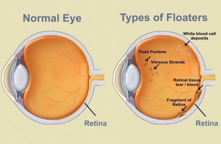 pearl_optics_Floaters